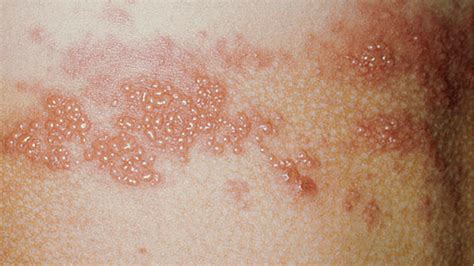 sintomas herpes zoster